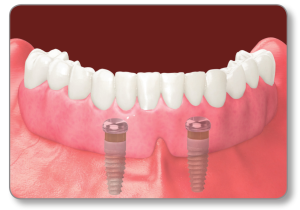 Implant Supported Dentures