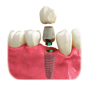Implant crowns