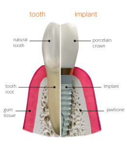 Illustration of a natural tooth and a dental implant