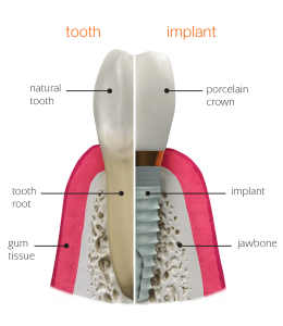 Illustration of a natural tooth and a dental implant