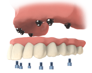 Teeth Xpress 