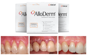 Gingival Grafts