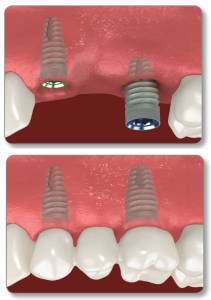 Implant Bridges